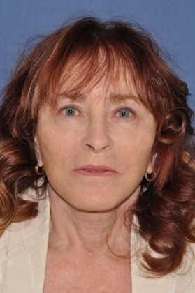 Facelift: Deep Plane second Face and Neck Lift and Upper lid Lift - After