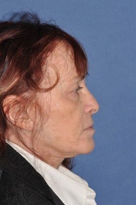 Facelift: Deep Plane second Face and Neck Lift and Upper lid Lift - Before