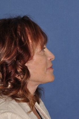 Facelift: Deep Plane second Face and Neck Lift and Upper lid Lift - After