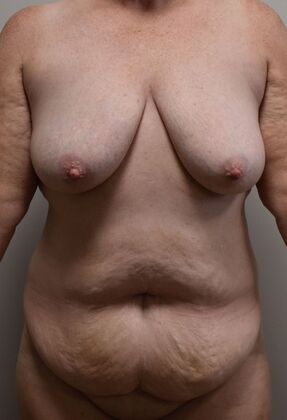 Mommy Makeover Case 353 - Before