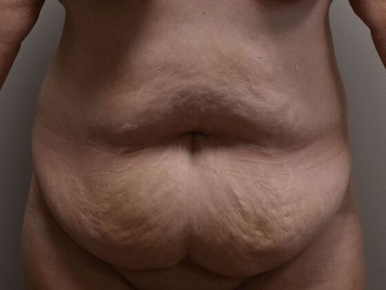 Tummy Tuck (Abdominoplasty) Case 557 - Before