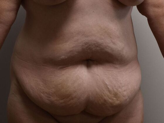 Tummy Tuck (Abdominoplasty): Case 557 - Before