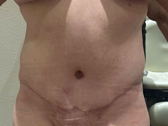 Tummy Tuck (Abdominoplasty): Case 557 - After