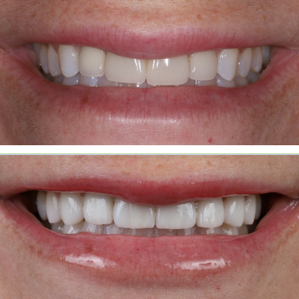 Minimal Prep Porcelain Veneers Rachel - Before