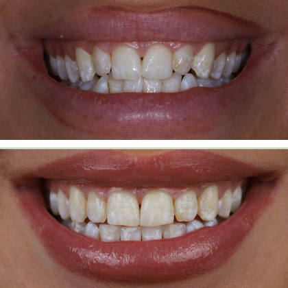 Invisalign / CandidPro Ashley - Before