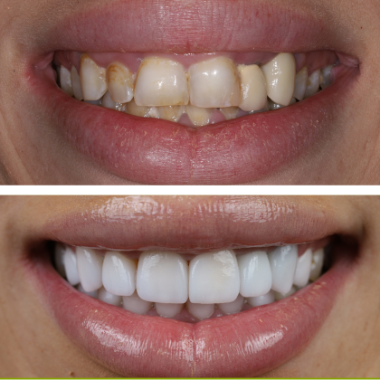 Full Mouth Rehabilitation Lindsey - Before