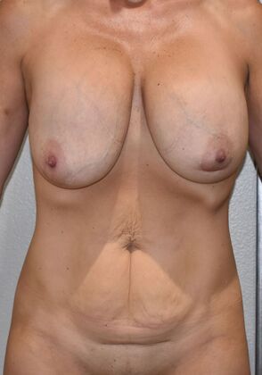 Massive Weight Loss  Case 190 - Before