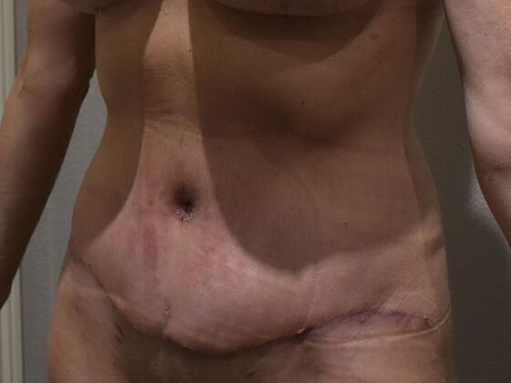 Tummy Tuck (Abdominoplasty): Case 558 - After