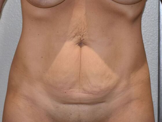 Tummy Tuck (Abdominoplasty) Case 558 - Before