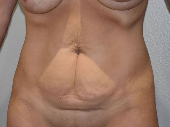 Tummy Tuck (Abdominoplasty): Case 558 - Before