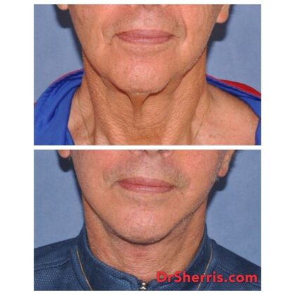 Facelift: 78 is the new 50! Private man allows his neck to be shown only 5 weeks after deep plane face and neck with deep neck fat removal! - Before and 5 weeks after