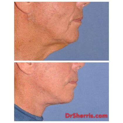 Facelift: 78 is the new 50! Private man allows his neck to be shown only 5 weeks after deep plane face and neck with deep neck fat removal! - Before and after