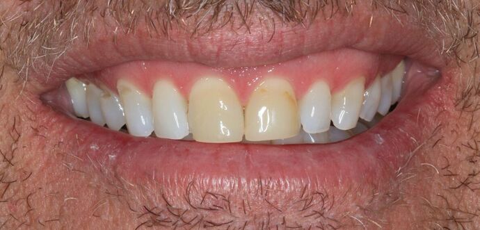 Full Mouth Reconstruction: Case 49 - Before