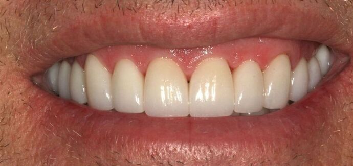 Full Mouth Reconstruction: Case 49 - After