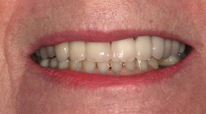 Full Mouth Reconstruction: Case 50 - Before