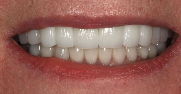 Full Mouth Reconstruction: Case 50 - After