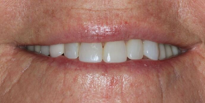 Porcelain Crowns Case 20 - Before