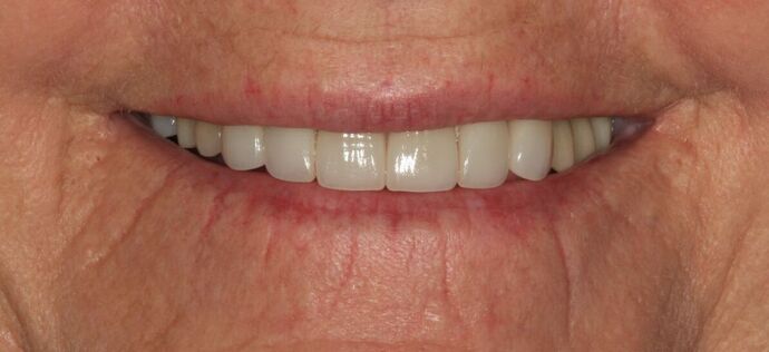 Porcelain Crowns Case 20 - After