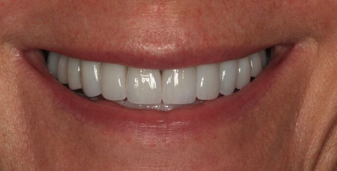 Full Mouth Reconstruction: Case 51 - After