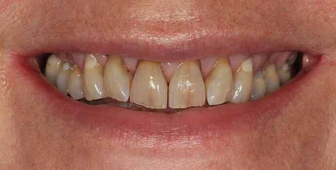 Full Mouth Reconstruction: Case 51 - Before