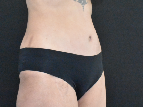 Abdominoplasty: Case 35 - After