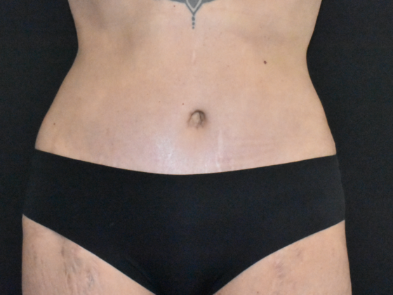 Abdominoplasty: Case 35 - After