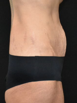 Abdominoplasty: Case 35 - Before