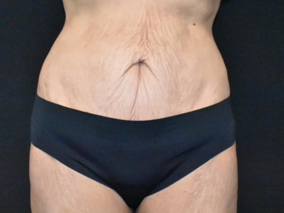 Abdominoplasty: Case 35 - Before