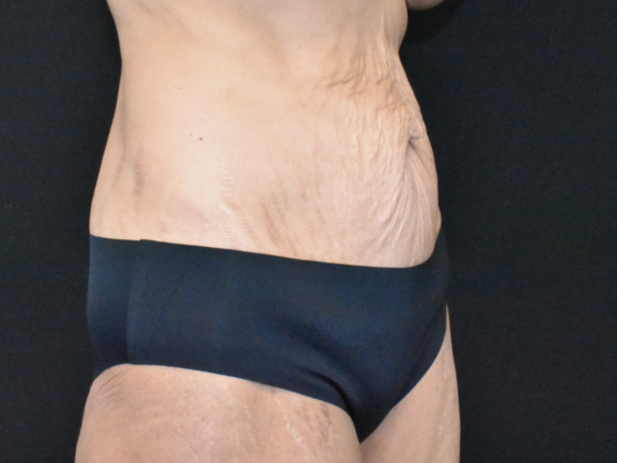 Abdominoplasty: Case 35 - Before