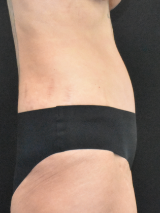 Abdominoplasty: Case 35 - After