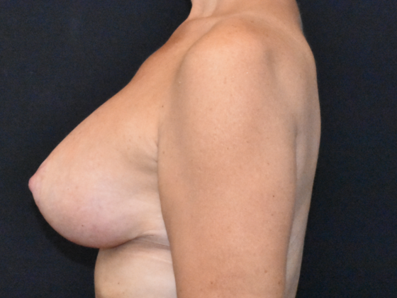 Breast Augmentation: Case 28 - After