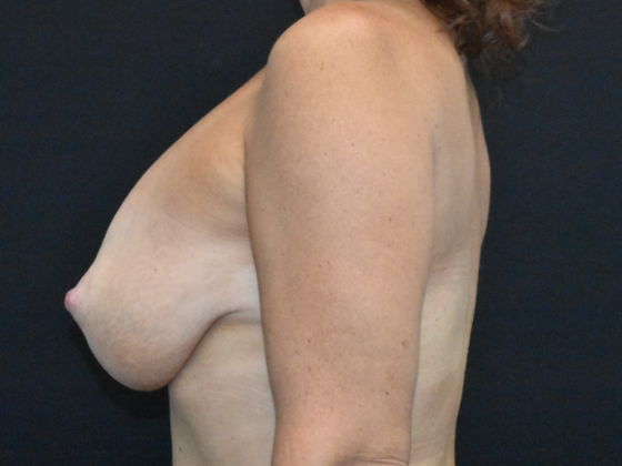 Breast Augmentation: Case 28 - Before