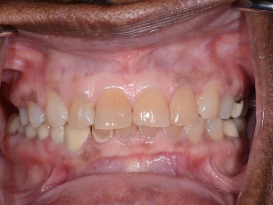 Full Mouth Rehabilitation Case 1 - Before