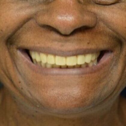 Full Mouth Rehabilitation: Case 1 - After