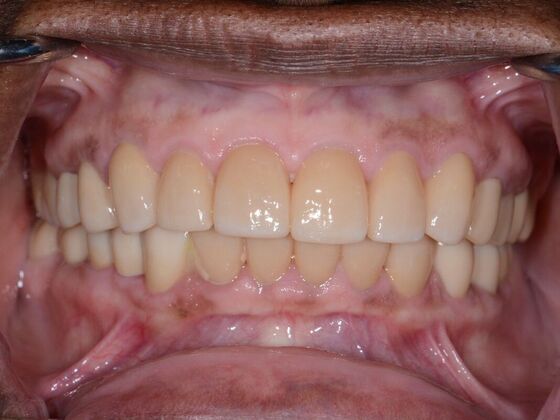 Full Mouth Rehabilitation Case 1 - After