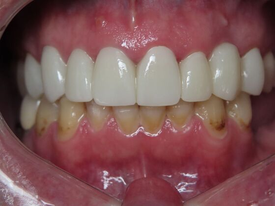 Crowns Case 4 - After
