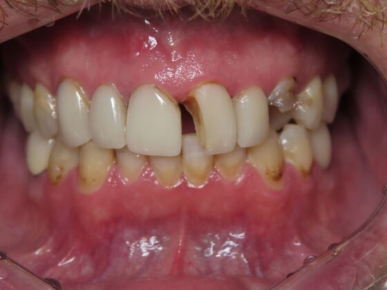 Crowns Case 4 - Before
