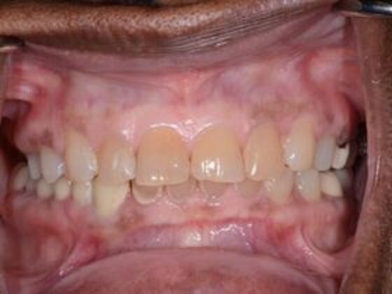 Smile Transformations Case 2 - Before