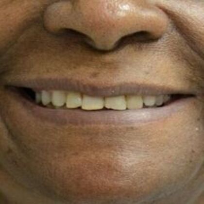 Smile Transformations: Case 2 - Before