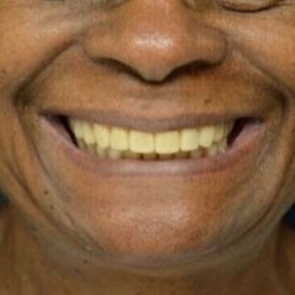 Smile Transformations: Case 2 - After