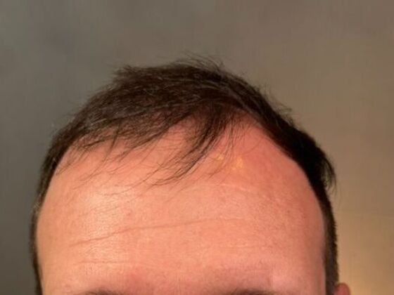 Hair Transplant Results Case 5 - Before