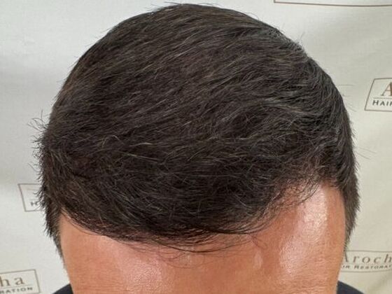 Hair Transplant Results: Case 5 - After