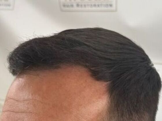 Hair Transplant Results: Case 5 - After