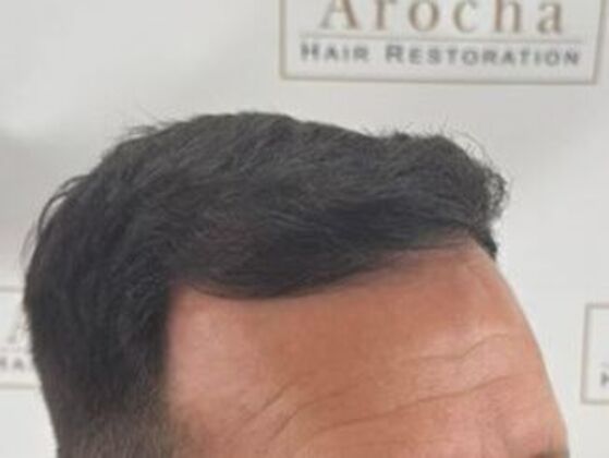 Hair Transplant Results: Case 5 - After