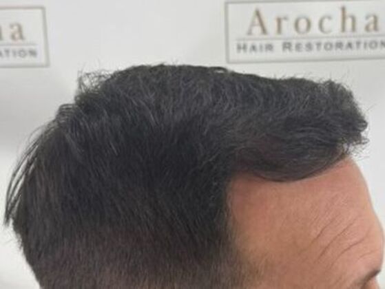 Hair Transplant Results: Case 5 - After