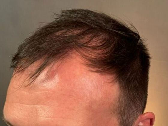 Hair Transplant Results: Case 5 - Before