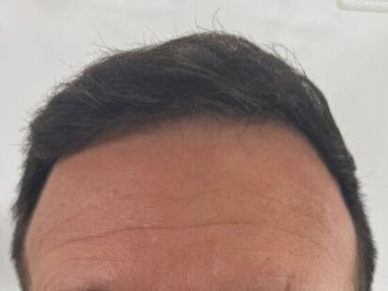 Hair Transplant Results Case 5 - After