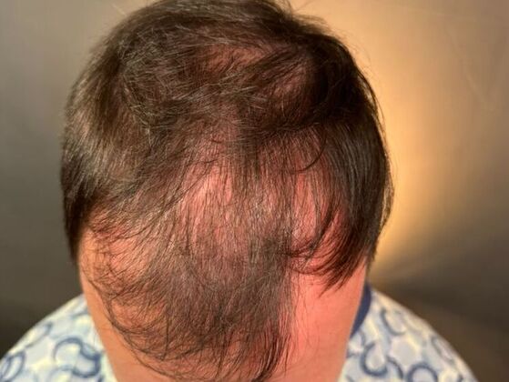 Hair Transplant Results: Case 5 - Before