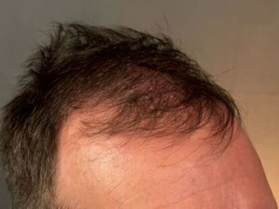 Hair Transplant Results: Case 5 - Before