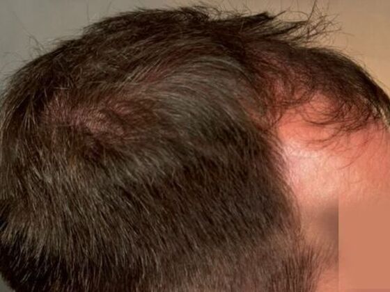 Hair Transplant Results: Case 5 - Before